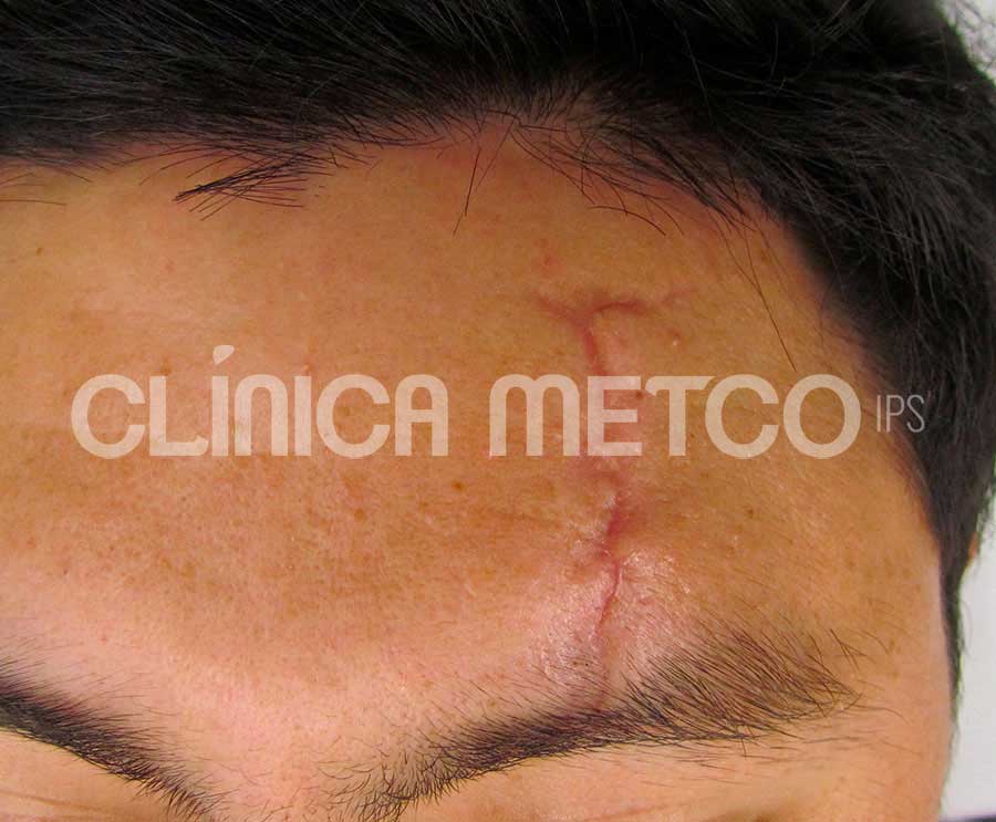 Cicatrices Después de Cirugía Estética